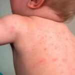 Protege a niñas y niños del dengue con estas recomendaciones de la SSM