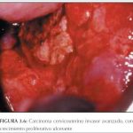 Esto es lo que debes saber sobre el cáncer cervicouterino